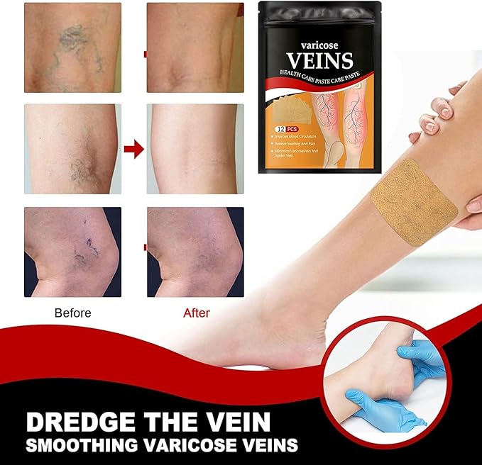 Varicose Veins Treatment Patch,12 Pcs Varicose Veins Remover for Legs Patch Spider Veins Removal for Legs Patch